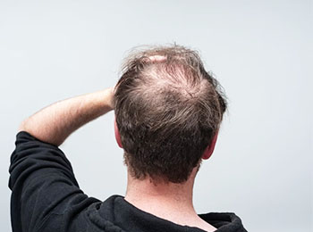 Alopecia treatment in Jalandhar