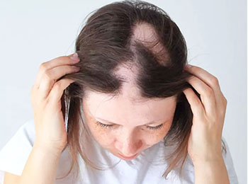 Alopecia treatment in homeopathy