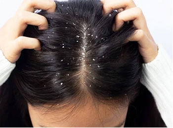 Dandruff treatment in homeopathy