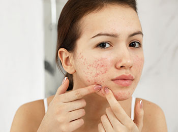 Acne and Scar treatment in Jalandhar