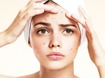 Acne and Scar treatment in homeopathy