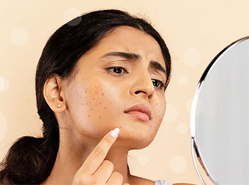 Blemishes treatment in Jalandhar