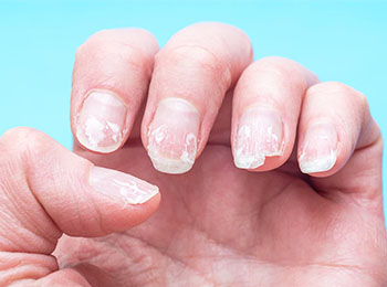 Brittle Nails treatment in Jalandhar
