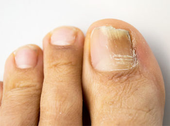 Brittle Nails treatment in homeopathy
