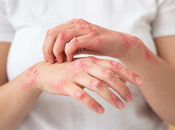 Eczema treatment in Jalandhar