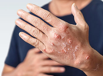 Eczema treatment in homeopathy