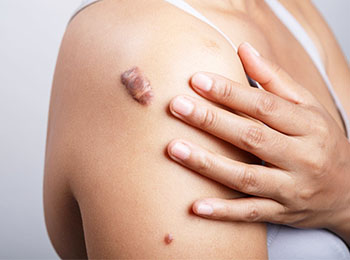 Keloids treatment in Jalandhar