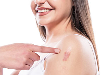 Keloids treatment in homeopathy