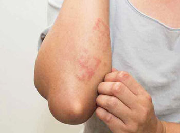 Lichen Planus treatment in homeopathy