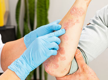 Psoriasis treatment in Jalandhar