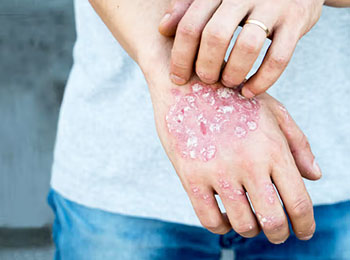 Psoriasis treatment in homeopathy