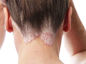 Seborrheic Dermatitis treatment in Jalandhar