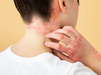Seborrheic Dermatitis treatment in homeopathy