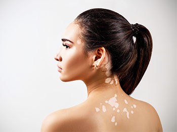 Vitiligo treatment in Jalandhar
