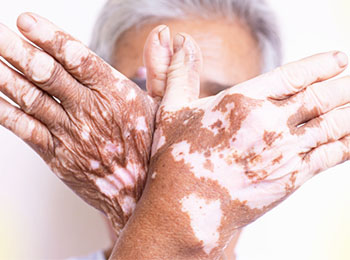 Vitiligo treatment in homeopathy
