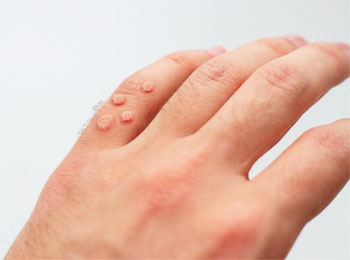 Warts treatment in Jalandhar