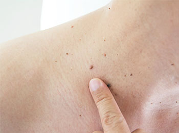 Warts treatment in homeopathy